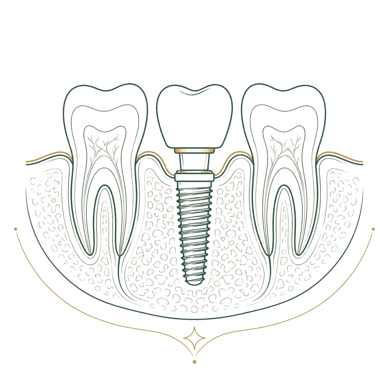 Çene kemiğine yerleştirilmiş diş implantı, dayanak ve kron kesit çizimi